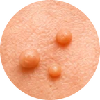 Close-up of skin tags